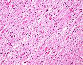 Diffuse astrocytoma, light micrograph
