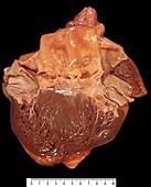 Human aortic valve