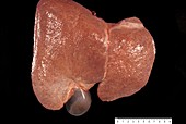 Cirrhosis of the liver