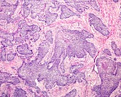 Basaloid squamous cell carcinoma, light micrograph
