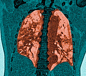 Covid-19 affected lungs