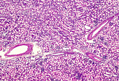 Human glomerulosclerosis of the kidney, light micrograph