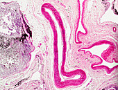 Smoker's lung, light micrograph