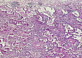 Small cell lung cancer, light micrograph