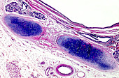 Squamous metaplasia of the lung, light micrograph