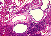 Pulmonary fibrosis, light micrograph