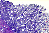 Langerhans cell histiocytosis, light micrograph