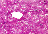 Human fatty liver disease , light micrograph