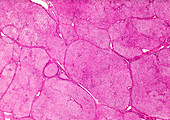 Human liver cell hydropic degeneration, light micrograph