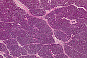 Acute haemorrhagic pancreatic necrosis, light micrograph