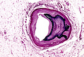 Atherosclerotic calcification, light micrograph