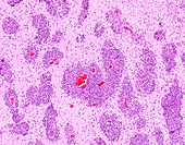 Diffuse large B-cell lymphoma AIDS-related, light micrograph