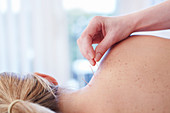 Woman receiving acupuncture in shoulder