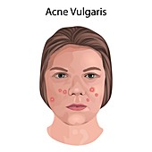 Acne vulgaris, illustration