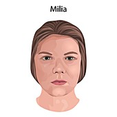 Milia, illustration