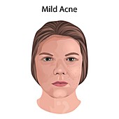 Mild acne, illustration