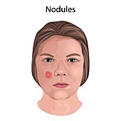 Nodules, illustration