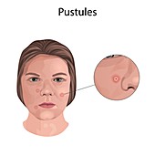 Pustules, illustration