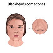 Blackhead comedones, illustration