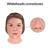 Whitehead comedones, illustration