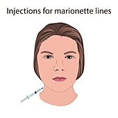 Injections for marionette lines, illustration