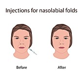 Injections for nasolabial folds, illustration