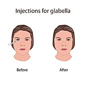 Injections for glabella, illustration