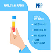 Platelet rich plasma medical use, illustration