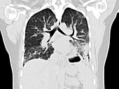Lungs with vaping damage, CT scan