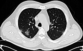 Lungs affected by Covid-19 pneumonia, CT scan
