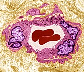 Testicular cancer capillary, TEM