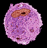 Lung cancer cell, TEM