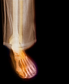 Lower leg in trousers, X-ray