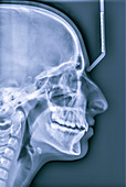 Skull measurement, X-ray
