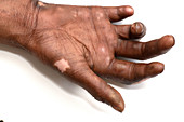 Hand affected by leprosy