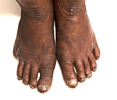 Feet affected by leprosy