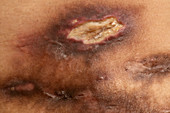 Panniculitis skin disorder