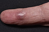 Bone tumour of the finger