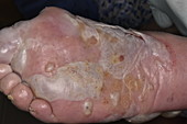 Bullous pemphigoid blisters