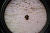 Mole, dermatoscope image