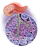 Pancreatitis, Illustration