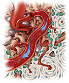 Hypercalcemia, Illustration