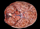 Human Brain, Meningeal Congestion