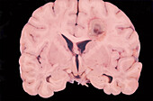 Human Brain Cyst