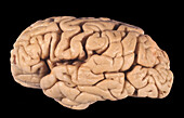 Human Brain, Cortical Atrophy