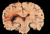 Human Brain, Hemorrhagic Infarct