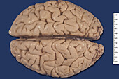 Human brain. Cortical atrophy