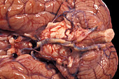 Human Brain, Plaques in the Circle of Willis