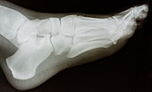 X-Ray, Lateral View of Left Foot
