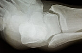 X-ray of Ankle, Lateral View